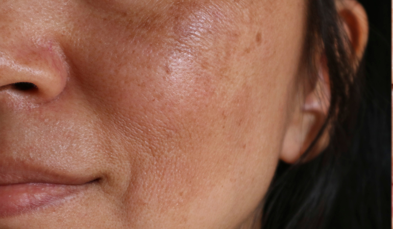 What is the difference between melasma and blotchy pigmentation?