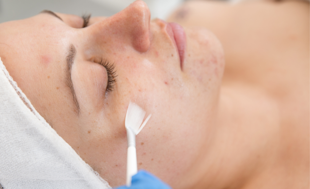 Rejuvenating Winter Skin with a Facial Peel