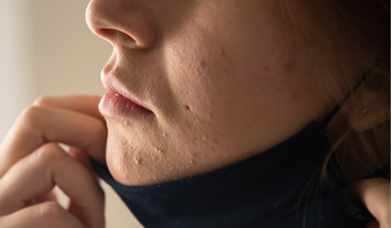 Oh no!! Maskne! Is your mask causing skin irritations?