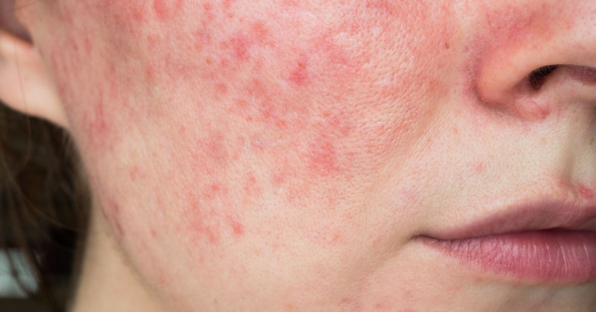 Rosacea: What’s Causing it and 5 Skin Care Ingredients to Avoid