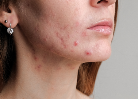 Woman with acne on her face and neck against a neutral background