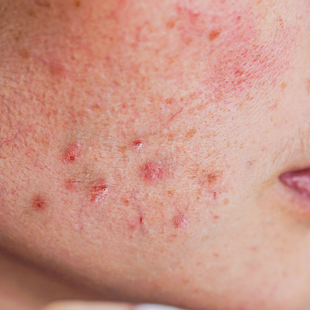 Close-up of a person's face with visible acne on the cheek.