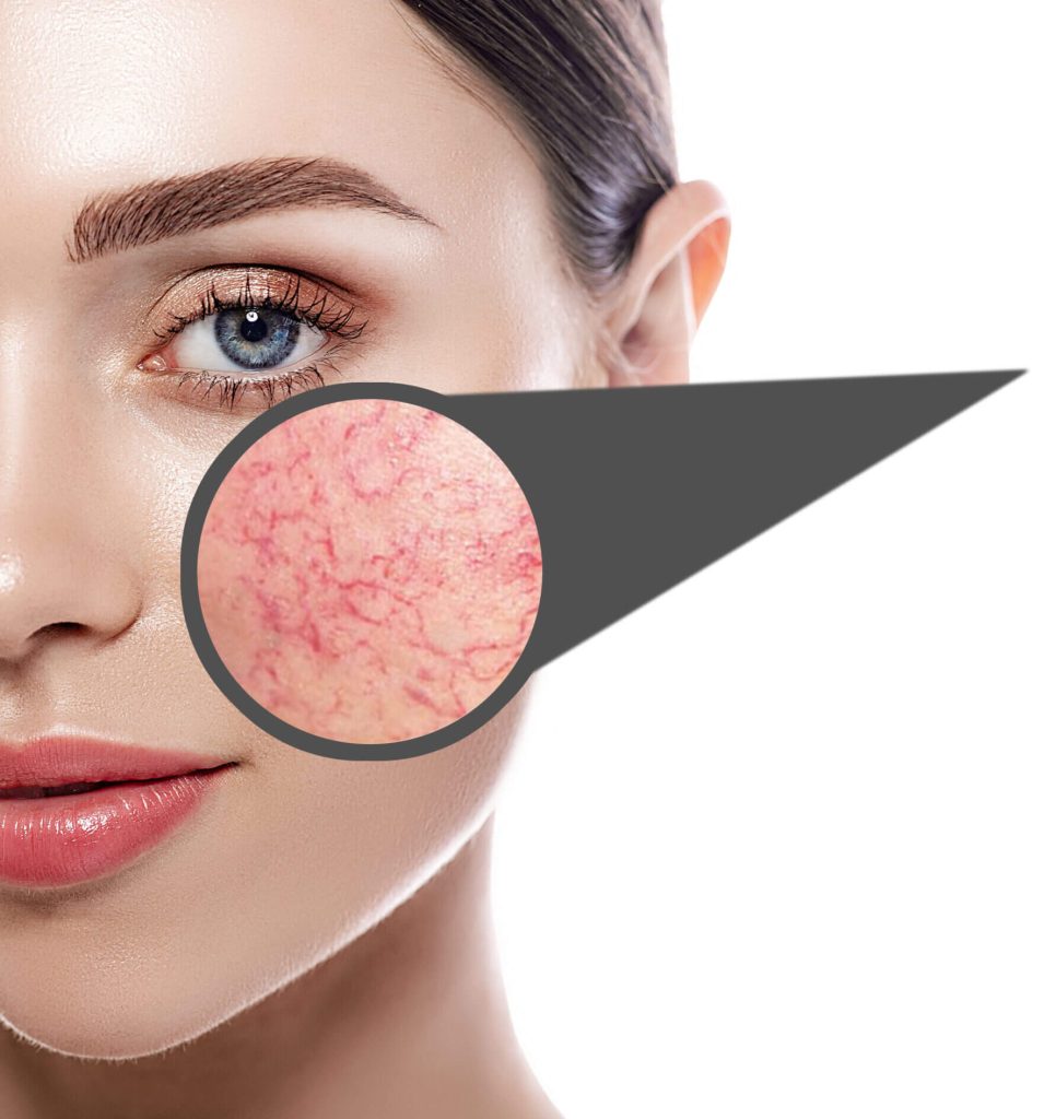 Lumenis M22 IPL (Vascular)