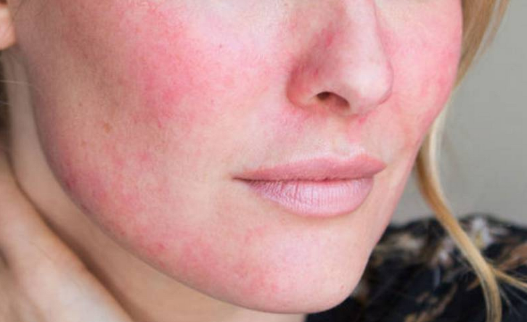 Let’s say goodbye to broken capillaries. For good!