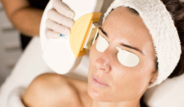 Laser vs IPL for Skin Pigmentation