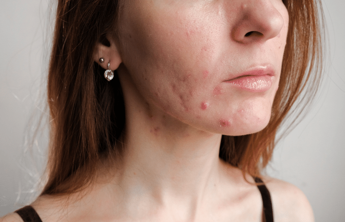 How to treat and prevent hormonal acne
