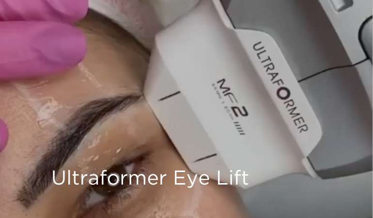 Non surgical eye lift and tightening with Ultraformer III