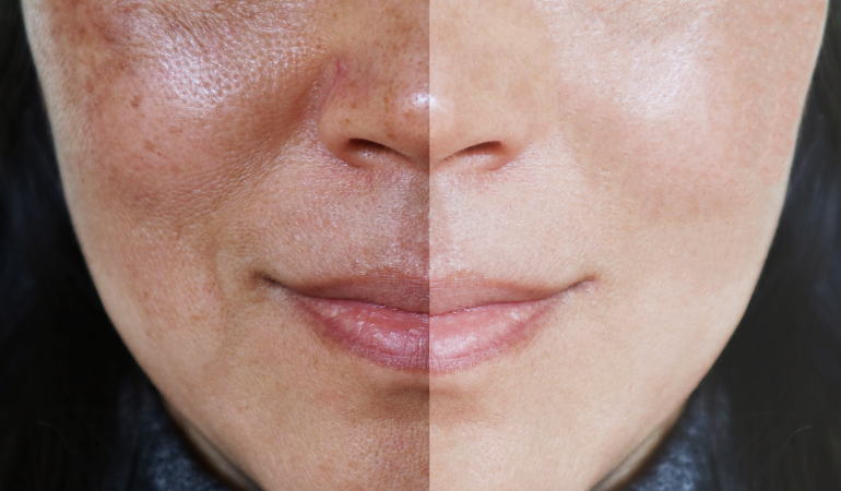 Non Surgical Skin Rejuventation: A Step by Step Treatment Plan