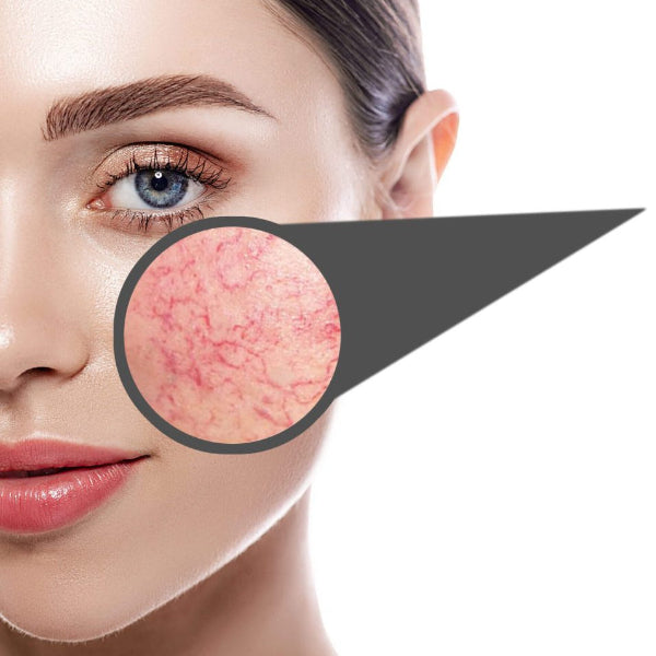 IPL Lumenis Select Skin Sydney
