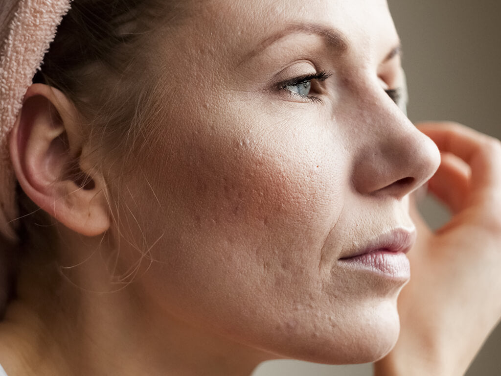 Acne Treatment
