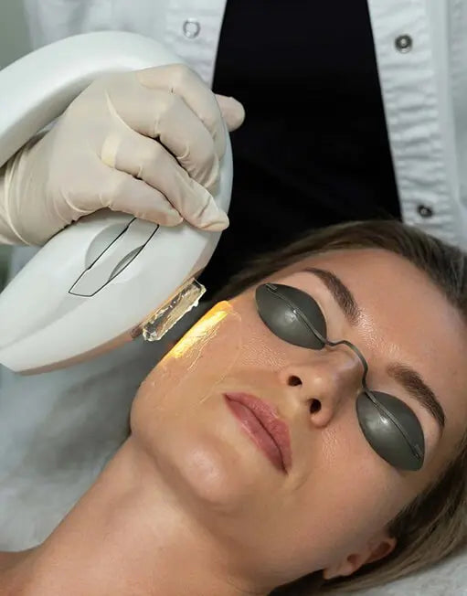 IPL Treatment – Lumenis M22